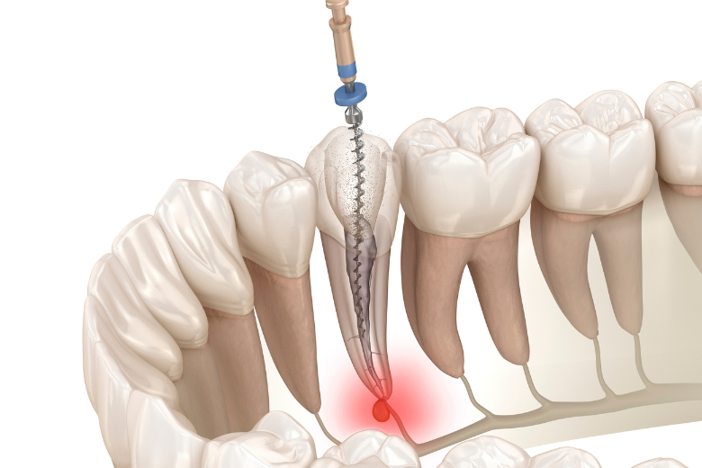 外苑前（東京）の歯医者、Angel矯正歯科・歯科口腔外科でマイクロスコープ精密治療