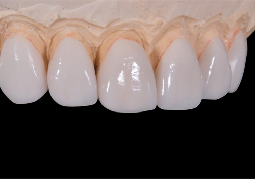 外苑前（東京）の歯医者、Angel矯正歯科・歯科口腔外科でむし歯治療