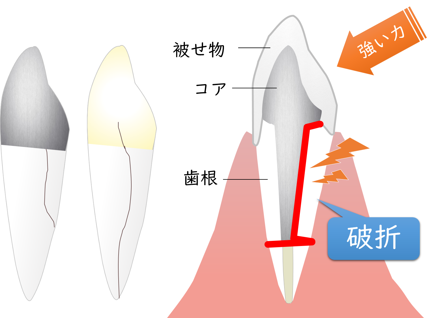 外苑前（東京）の歯医者、Angel矯正歯科・歯科口腔外科の根管治療