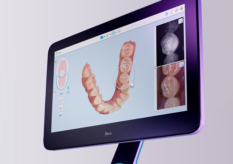 外苑前（東京）の歯医者、Angel矯正歯科・歯科口腔外科の口腔内スキャナーiTero(アイテロ)