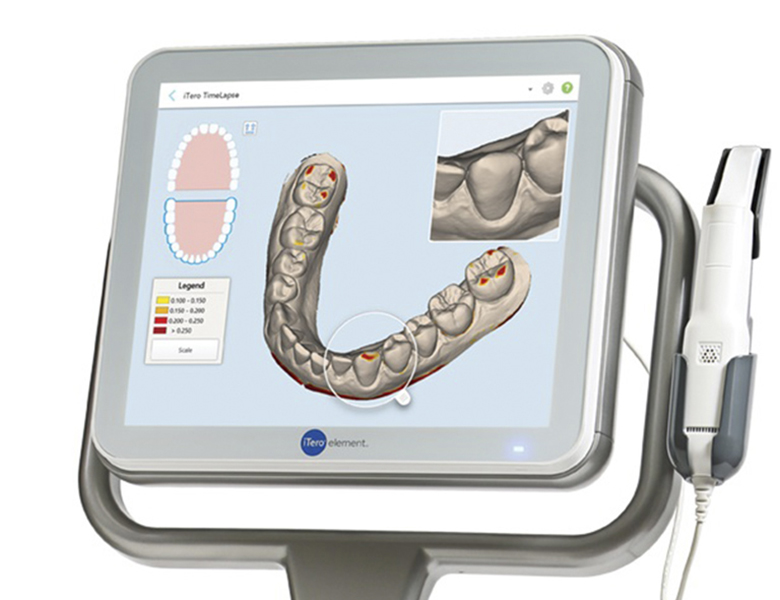 東京都港区外苑前の歯医者、Angel矯正歯科・歯科口腔外科の口腔内スキャナー