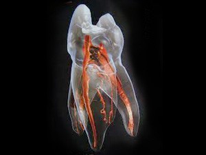 外苑前（東京）の歯医者、Angel矯正歯科・歯科口腔外科の根管治療