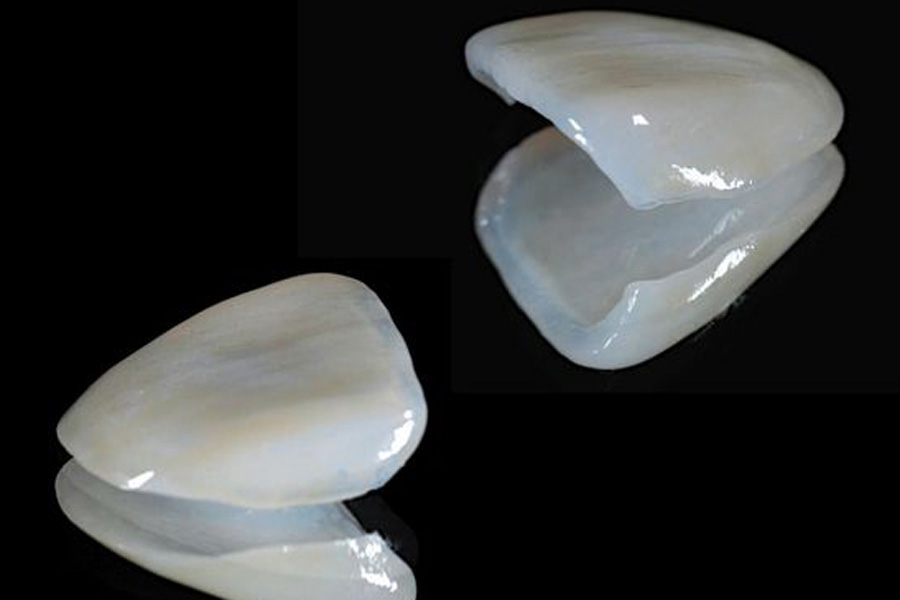 外苑前（東京）の歯医者、Angel矯正歯科・歯科口腔外科の審美歯科治療