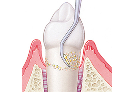 外苑前（東京）の歯医者、Angel矯正歯科・歯科口腔外科の歯周病治療