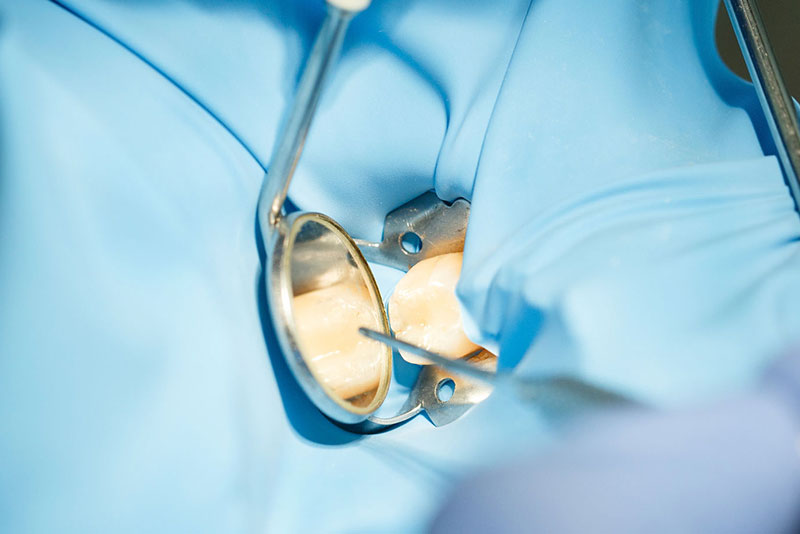 外苑前（東京）の歯医者、Angel矯正歯科・歯科口腔外科の根管治療