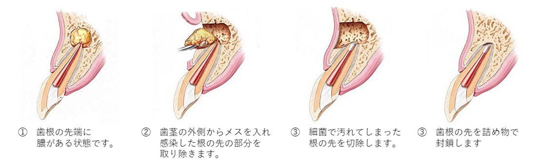 外苑前（東京）の歯医者、Angel矯正歯科・歯科口腔外科で歯根端切除術